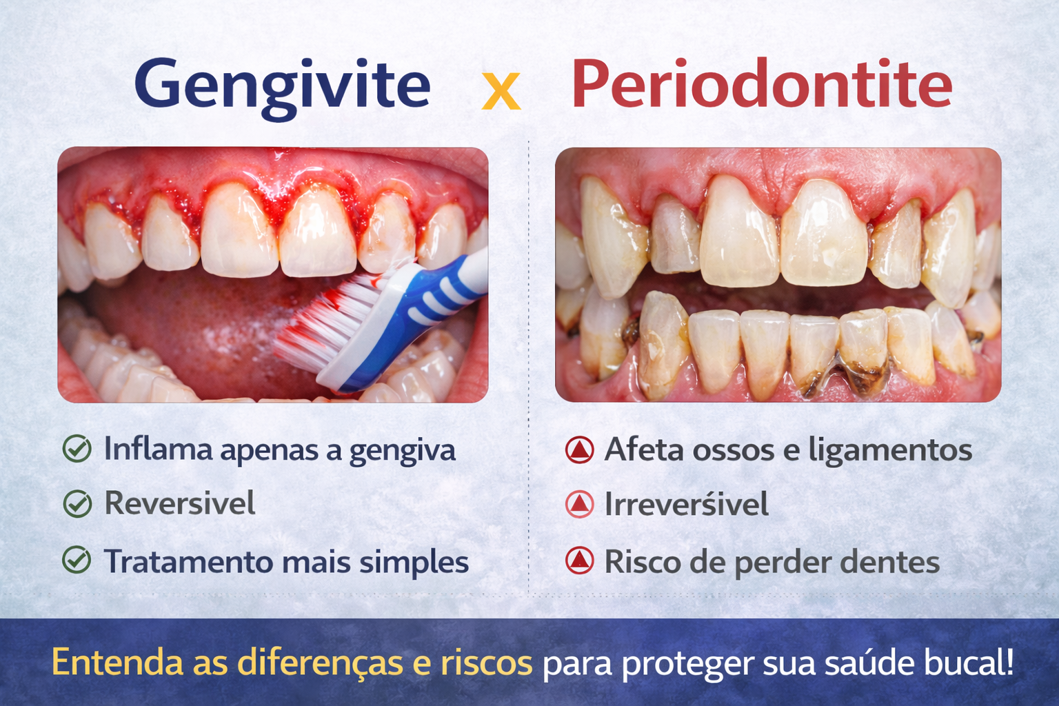 Gengivite x Periodontite: entenda as diferenças e riscos